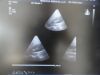 PHILIPS X3-1 P/N 21715A xMatrix Phased Array Ultrasound Transducer