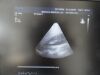 PHILIPS X3-1 P/N 21715A xMatrix Phased Array Ultrasound Transducer