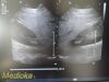 PHILIPS X6-1 Phased Array Ultrasound Transducer