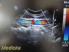 PHILIPS X6-1 Phased Array Ultrasound Transducer