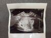 PHILIPS C10-3V Ultrasound Transducer