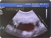 PHILIPS C5-2 Curved Array Probe / Ultrasound Transducer