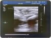 PHILIPS L9-3 LINEAR Ultrasound Transducer