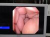 OLYMPUS GIF-P140 Gastroscope