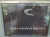 SONOSITE Micromaxx P08840-020 Portable Ultrasound Machine