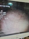 OLYMPUS PCF-H180AL EVIS EXERA Colonoscope