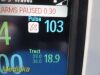 PHILIPS 2011  MP5 (M8105A) 865024 Multi-parameter Monitor