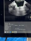 VITACON VitaScan LT  With Vitascan V2 Probe. Urology Ultrasound