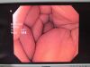 OLYMPUS GIF1TQ160 Gastroscope
