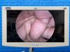 KARL STORZ IMAGE 1 Hub 222010 20 Laparoscope