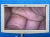 KARL STORZ IMAGE 1 Hub 222010 20 Laparoscope