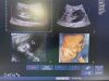 PHILIPS V6-2 Broadband Curved Volume Array Transducer, Volumetric Probe ~ Ultrasound Transducer