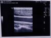 GE L8-18i-D Ultrasound Transducer