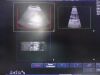 PHILIPS C5-1 Broadband Curved Array Ultrasound Transducer
