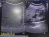 PHILIPS C5-1 Broadband Curved Array Ultrasound Transducer