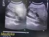 PHILIPS C5-1 Broadband Curved Array Ultrasound Transducer