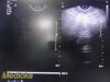 PHILIPS C9-5ec Ref 453561232031 Endocavity Ultrasound Transducer