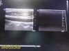 PHILIPS L12-5 Linear Array Ultrasound Transducer