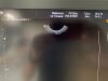 MEDISON Accuvix XG Ultrasound - OB / GYN - Vascular