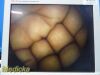 CABOT MEDICAL 10mm x 10° Rigid Telescope Ref 004873-901; Laparoscope