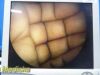 CABOT MEDICAL 10mm x 10° Rigid Telescope Ref 004873-901; Laparoscope