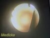 OLYMPUS BF-P20D Bronchoscope