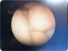 HOLOGIC MyoSure 40-200 Hysteroscope