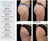 BTL 2020  Emtone Radio Frequency Cellulite Reduction & Smoothing with RF Handpiece – Free Shipping Laser - Radio Frequency (RF)