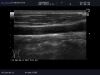 ALOKA UST-579T Ultrasound Transducer