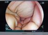 FUJINON EG760R Gastroscope