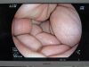 FUJINON EB-530H Bronchoscope