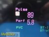 PHILIPS Intellivue MP50 Anesthesia , MMS CO IBP Print Modules Leads~ Anesthesia Monitor