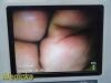 VERATHON 2018  0570-0338 Glidescope Titanium Video Monitor