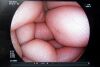 FUJIFILM EG-L600WR7 Endoscope