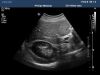 PHILIPS C5-1 Ultrasound Transducer