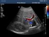 PHILIPS C5-1 Ultrasound Transducer