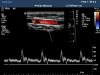 PHILIPS L12-5 Ultrasound Transducer