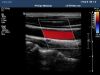 PHILIPS L9-3 Ultrasound Transducer