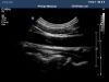 PHILIPS C8-5 Ultrasound Transducer