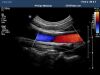 PHILIPS C8-5 Ultrasound Transducer