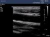 PHILIPS L15-7i0 Ultrasound Transducer