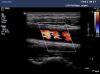 PHILIPS L15-7i0 Ultrasound Transducer