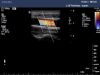 PHILIPS L15-7i0 Ultrasound Transducer