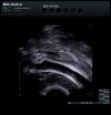 BK MEDICAL 8808 Ultrasound Transducer