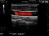 HITACHI L64 Ultrasound Transducer