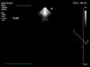 PHILIPS S5-1 Ultrasound Transducer