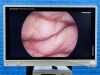 KARL STORZ 5.0 mm 0º Hopkins II Autoclavable Telescope, 24 cm Laparoscope