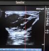 SONOSITE L25X/13-6 Ultrasound Transducer