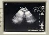SONOSITE C15 Ultrasound Transducer