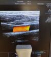 GE 11L-D Ultrasound Transducer